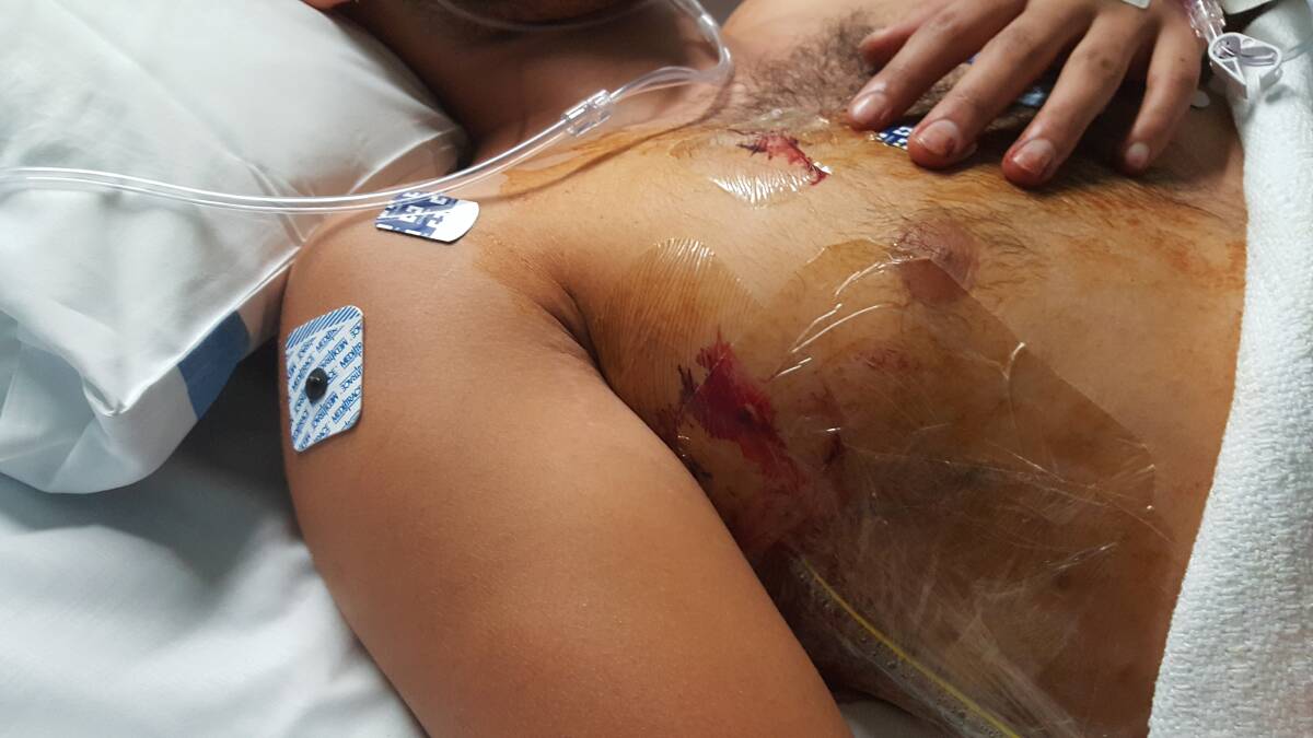 The 20-year-old man was stabbed on the right side of his chest, in between his fourth and fifth rib. Photo: Supplied