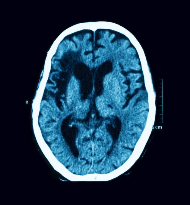 Diagnostics: The fresh bleed of a stroke would show up as a bright white in a CT scan. CT also has many other capabilities all over the body, and is quicker than MRI.