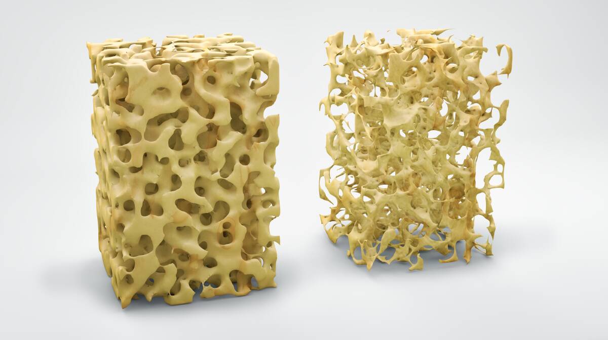Normal bone matrix (left) vs osteoporosis

