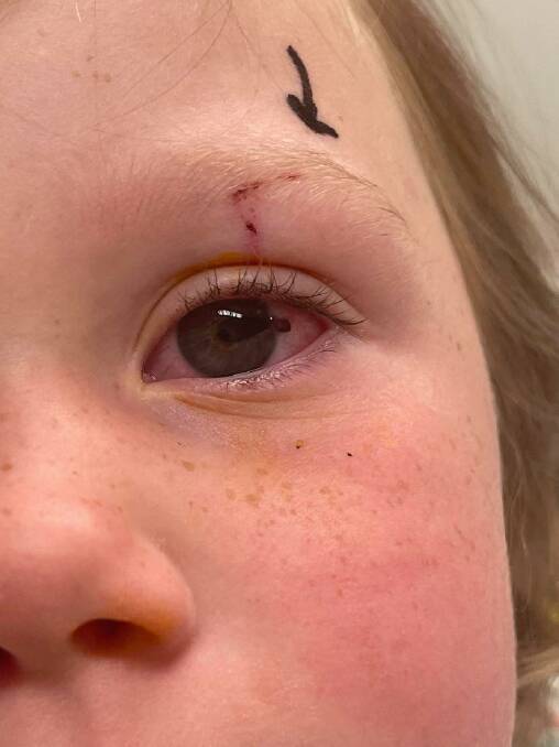 Swooping season: Zoe Butler had to have emergency surgery after a magpie scratched her eye. Photo: Supplied.
